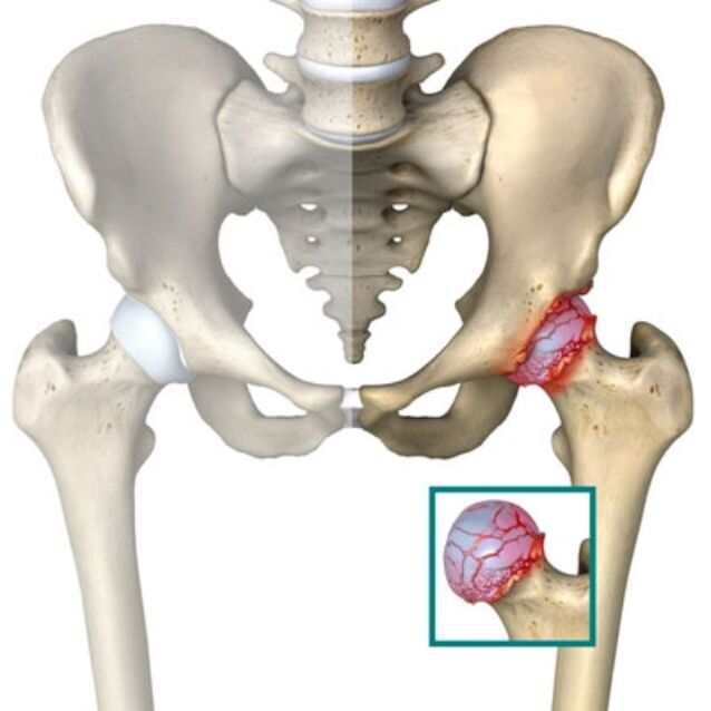 arthrosis of movik hip