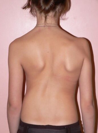 Scoliosis 2 derece