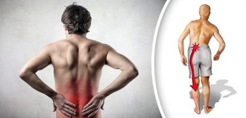 Sindroma êş bi Lumbar Osteochondrosis radibe ber lingan
