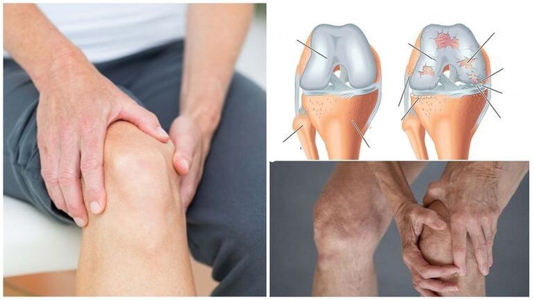 Nîşaneya êşê ya arthrossê ya hevbeş a kemikê