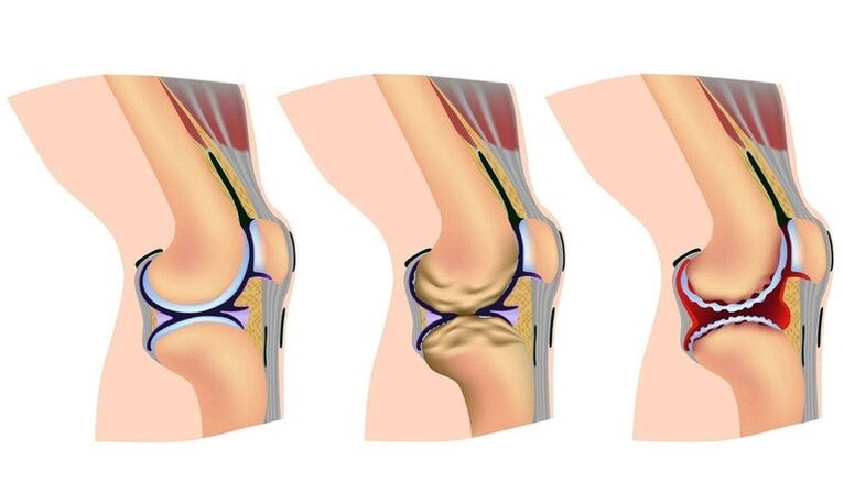 Qonaxên deformasyonê di hevbeşiya kokê de ji bo arthrossozê