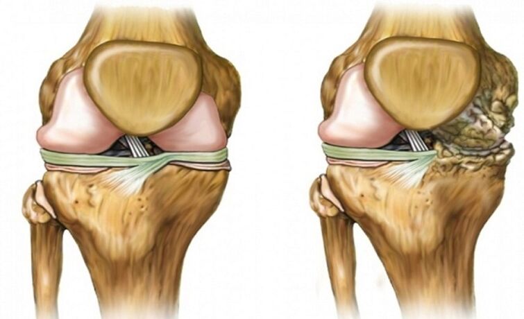 Tendurist û bandor ji arthrosis hevbeş