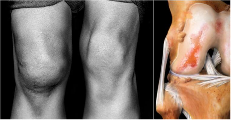 arthrossis of the knech hevbeş û hevpar