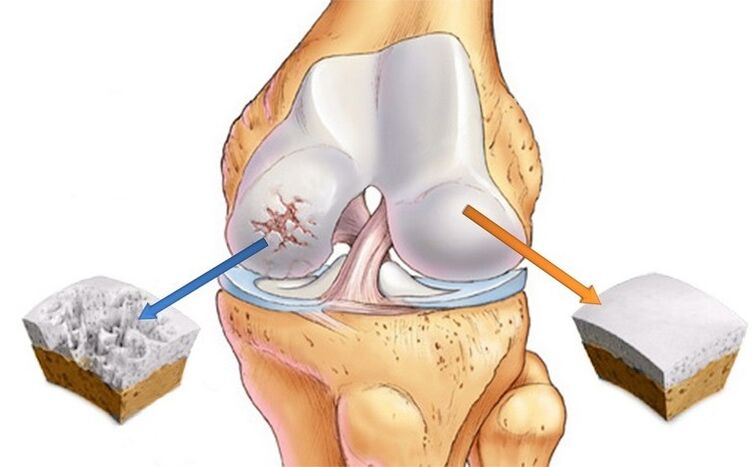 kartolên normal û ji arthrosisê bandor bûne