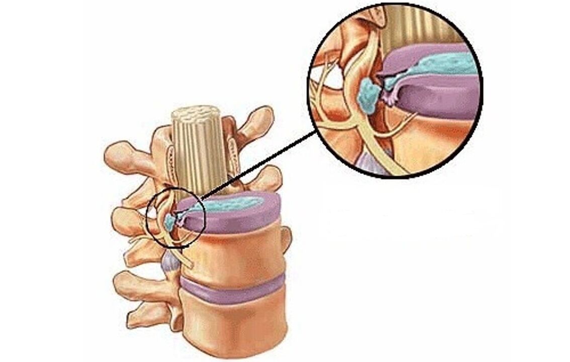 hernia intervertebral bi osteochondrosis thoracic