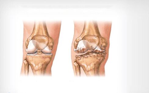 arthrosis movika çokê