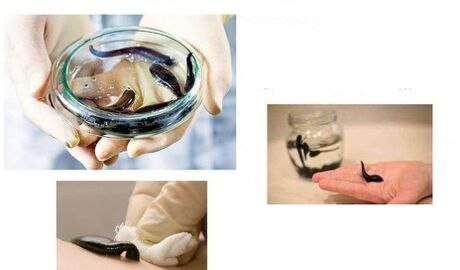 hirudotherapy ji bo arthrosis