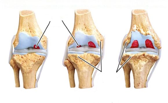 qonaxên arthrosisê çokê