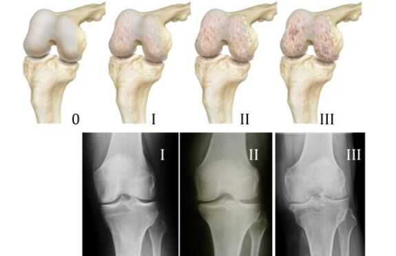 rêbazên ji bo teşhîskirina arthrosis çokê